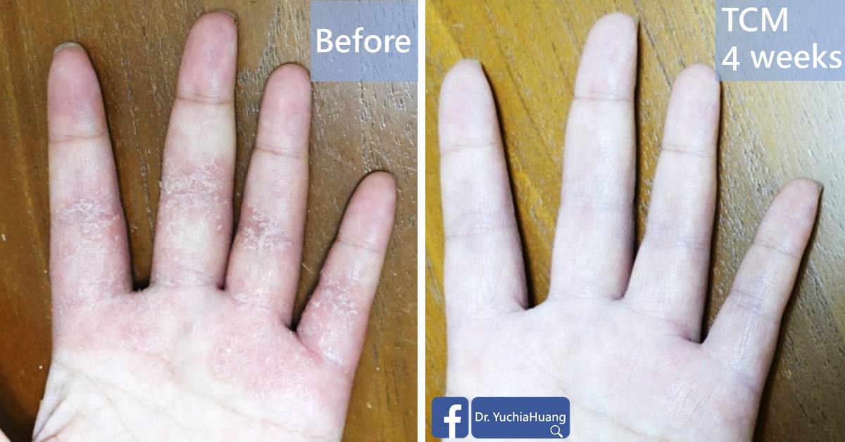 Before-and-after photos of a palm and fingers with hand eczema, labelled “Before” and “TCM 4 weeks”