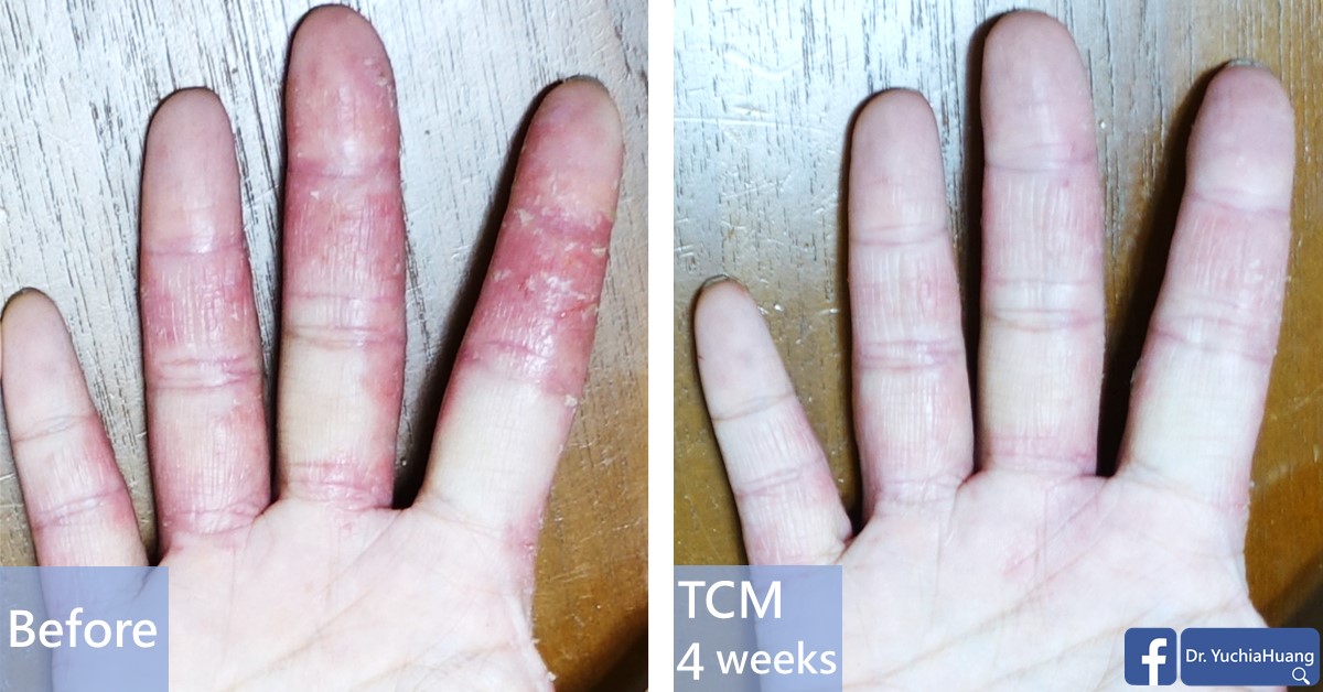 Before-and-after photos of red, peeling fingers, labelled “Before” and “TCM 4 weeks”