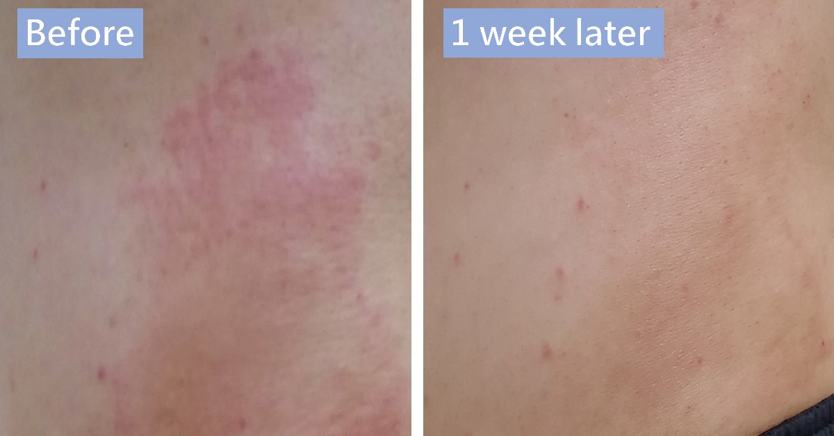 Before-and-after photos of a red patch of skin, labelled “Before” and “1 week later”
