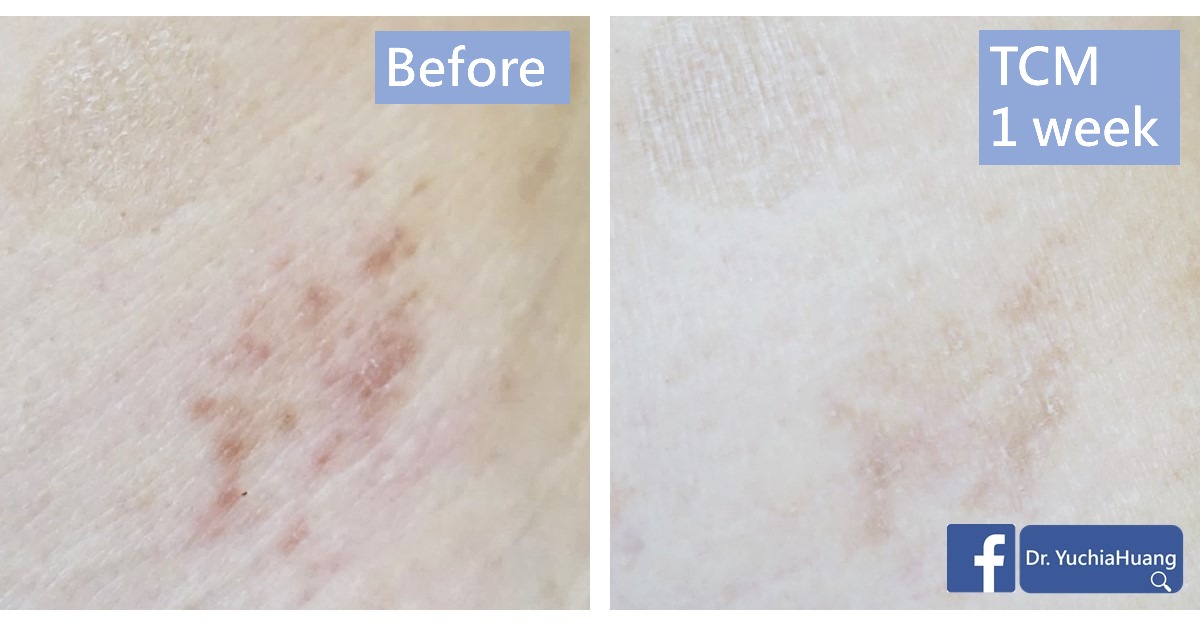 Before-and-after photos of brownish spots on the skin, labelled “Before” and “TCM 1 week”
