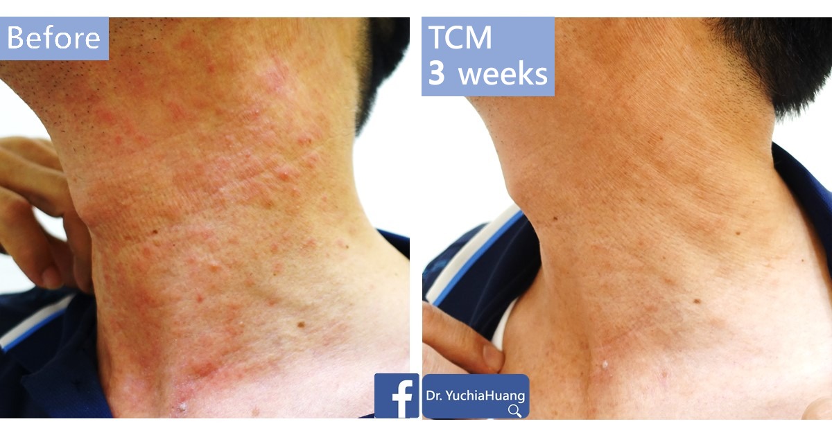 Before-and-after photos of red skin on the neck, labelled “Before” and “TCM 3 weeks”