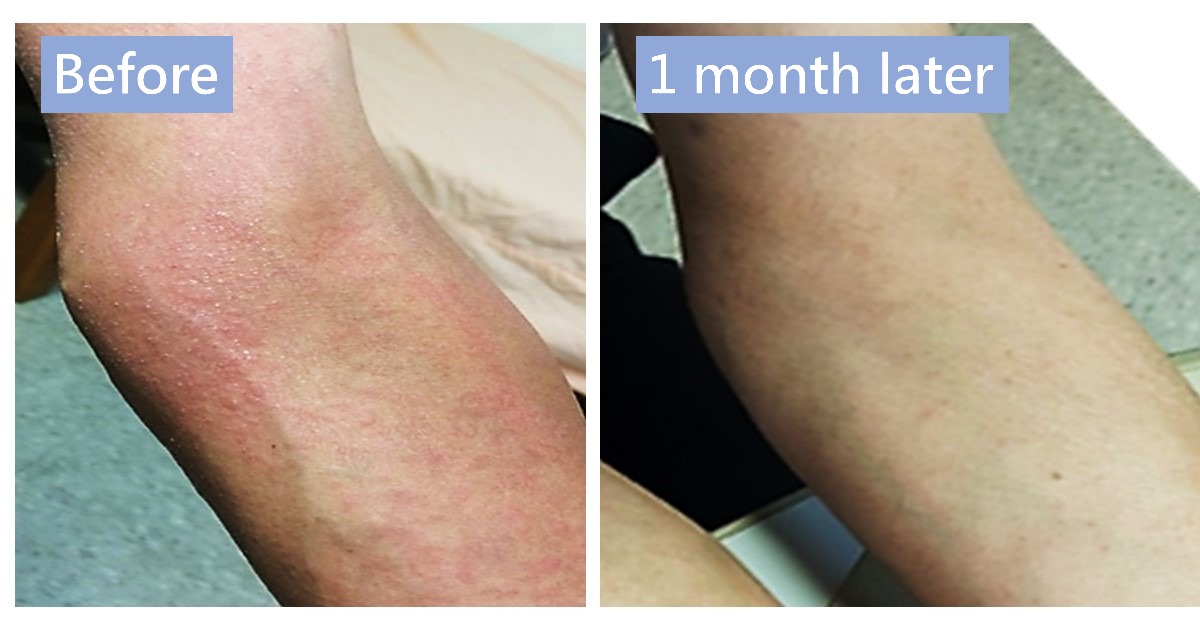 Before-and-after photos of red rash on an arm after a bone marrow transplant, labelled “Before” and “1 month later”