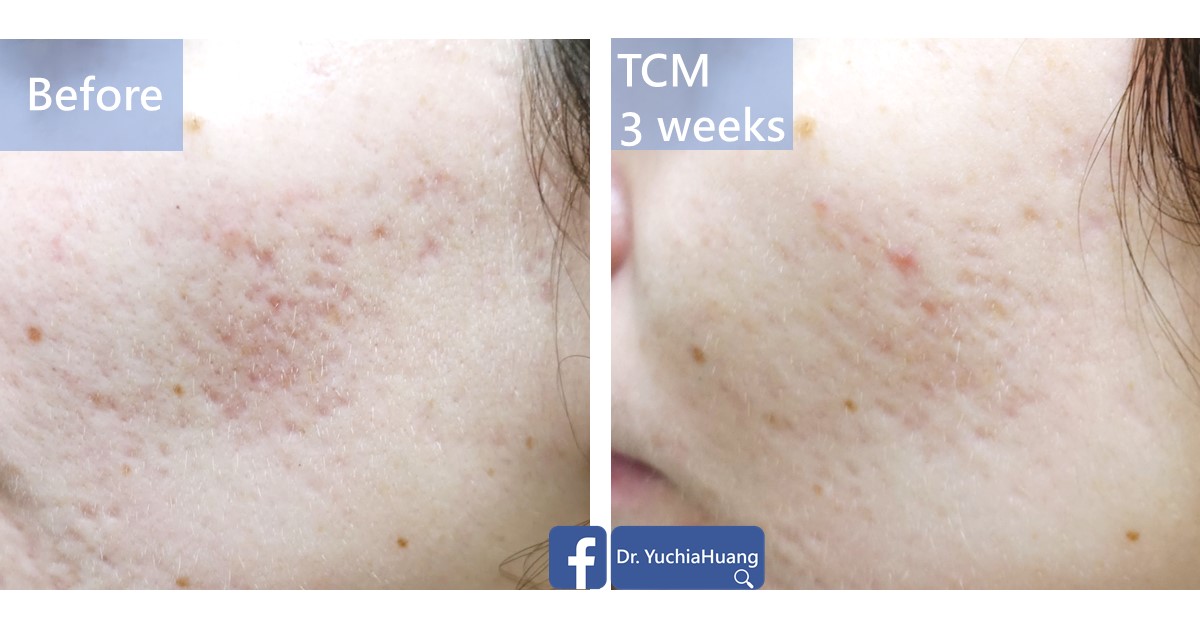 Before-and-after photos of a cheek with acne, labelled “Before” and “TCM 3 weeks”
