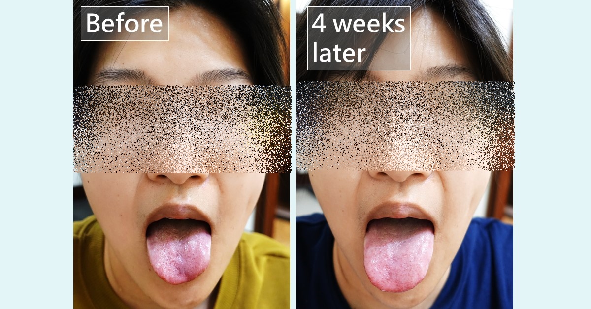 Before-and-after photos of a tongue, with the eyes obscured, labelled “Before” and “4 weeks later”