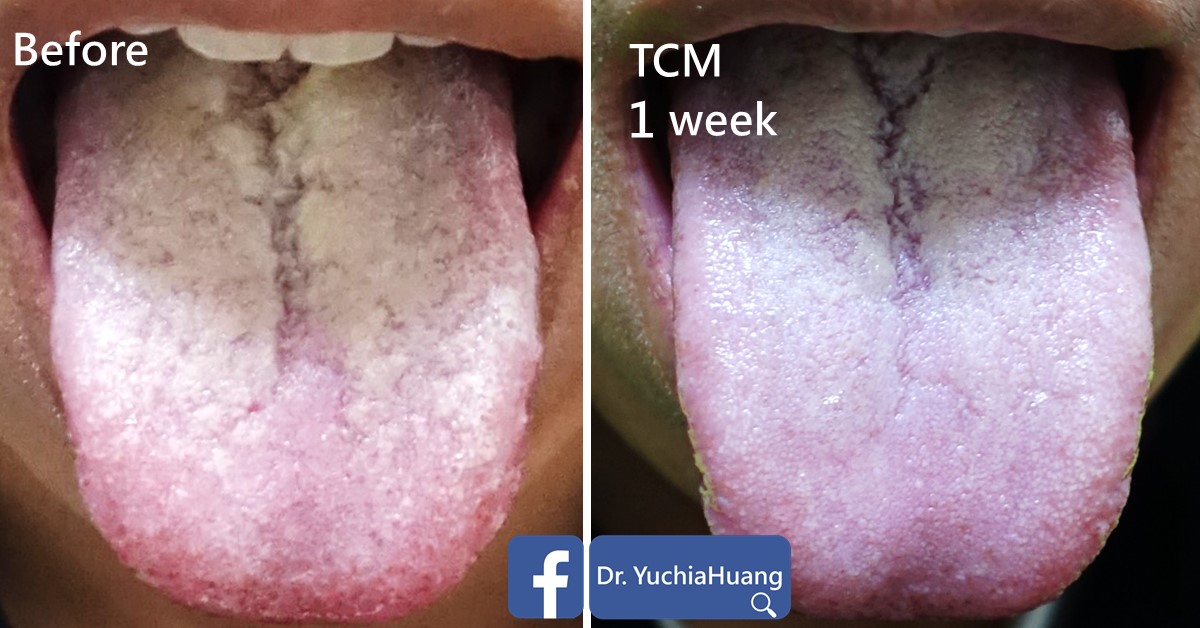 Before-and-after photos of a tongue with a thick coating, labelled “Before” and “TCM 1 week”