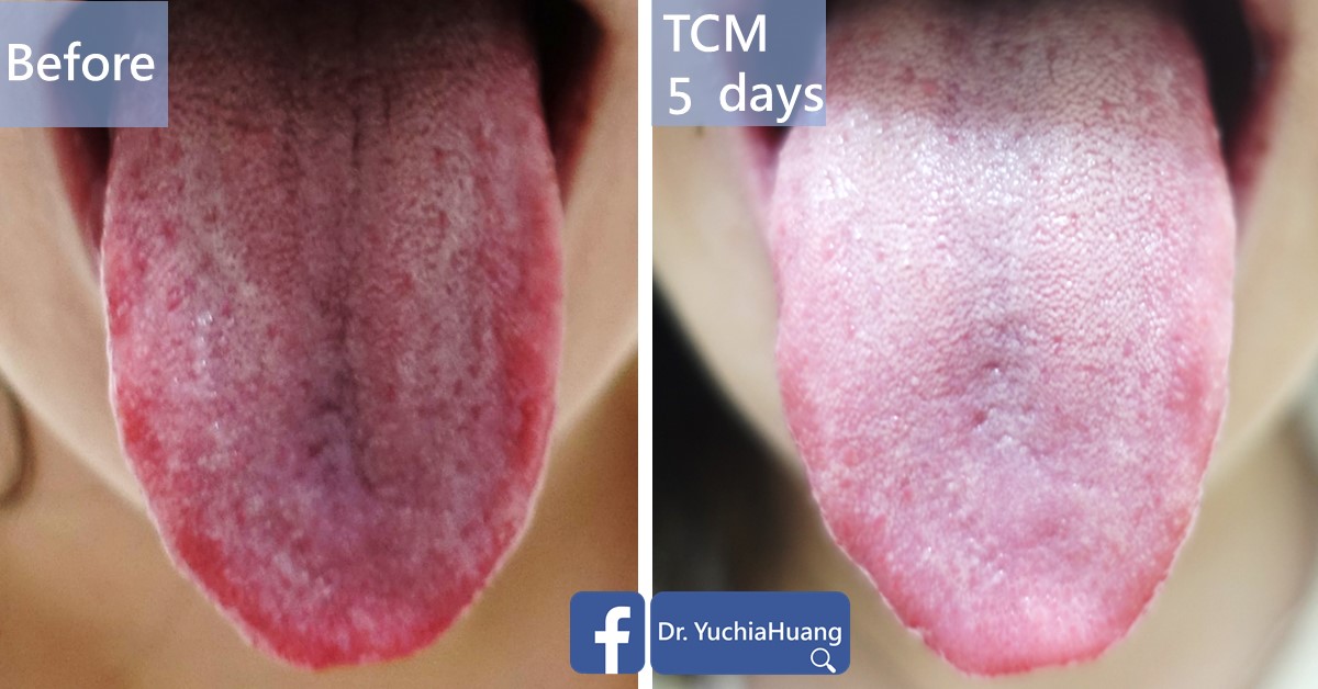 Before-and-after photos of a red tongue, labelled “Before” and “TCM 5 days”