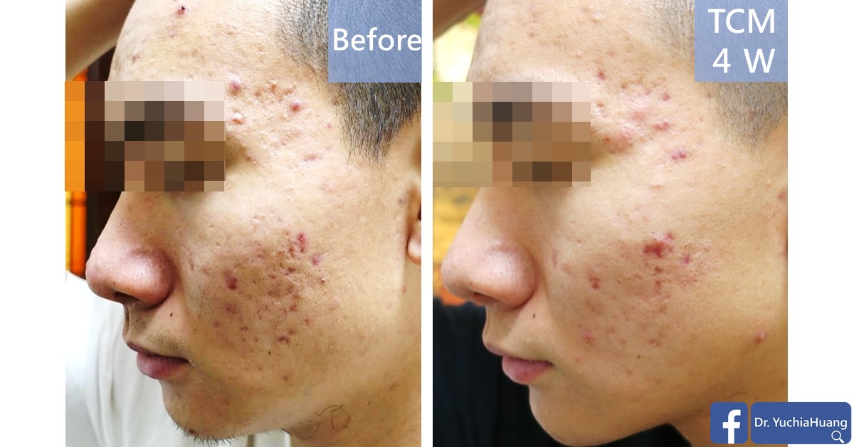 Before-and-after photos of the side of a man’s face with acne, labelled “Before” and “TCM 4 weeks”