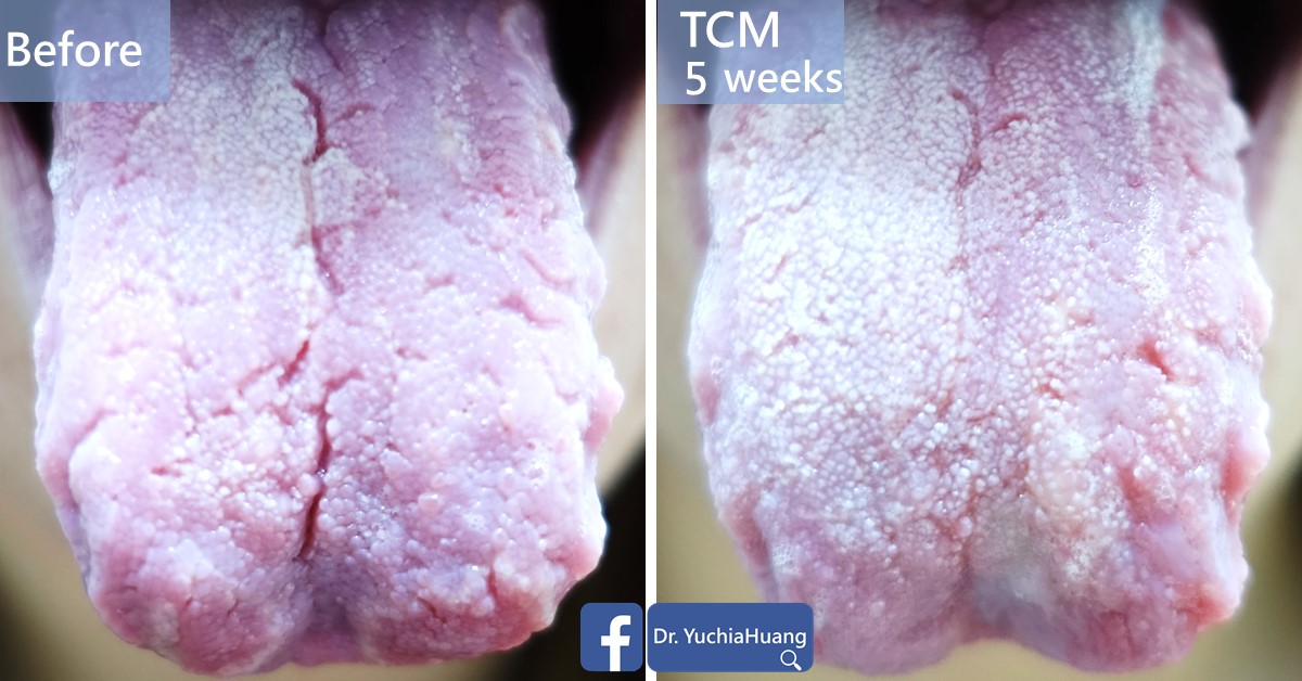 Before-and-after photos of a tongue with a thick white coating, labelled “Before” and “TCM 5 weeks”