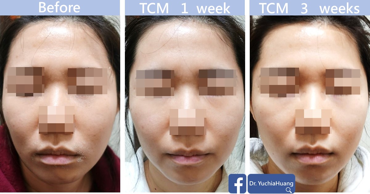 Before-and-after photos of a face, eyes, nose and mouth obscured, labelled “TCM 1 week” and “TCM 3 weeks”