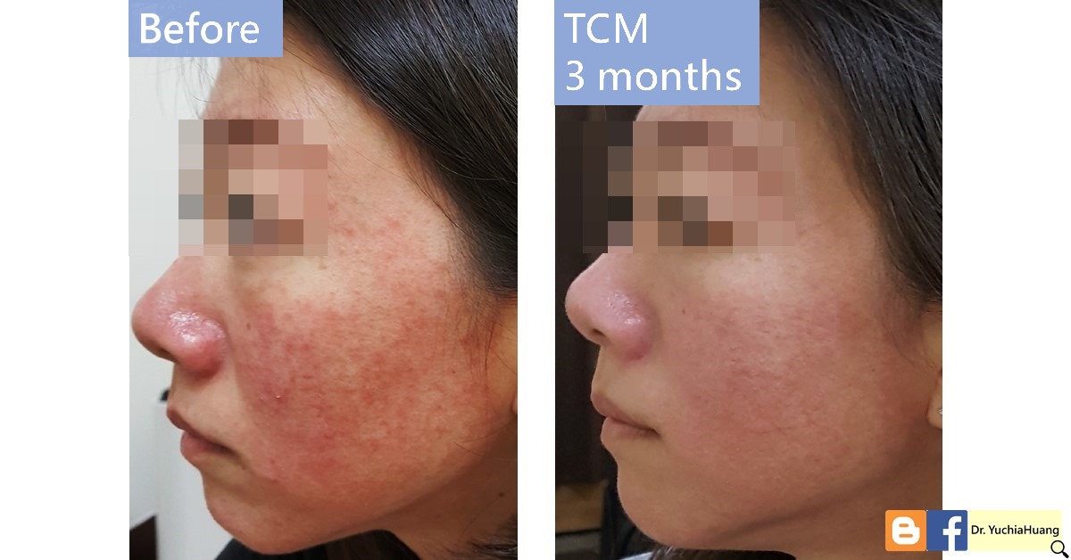 Before-and-after photos of the side of a face with redness on the cheek, labelled “Before” and “TCM 3 months”