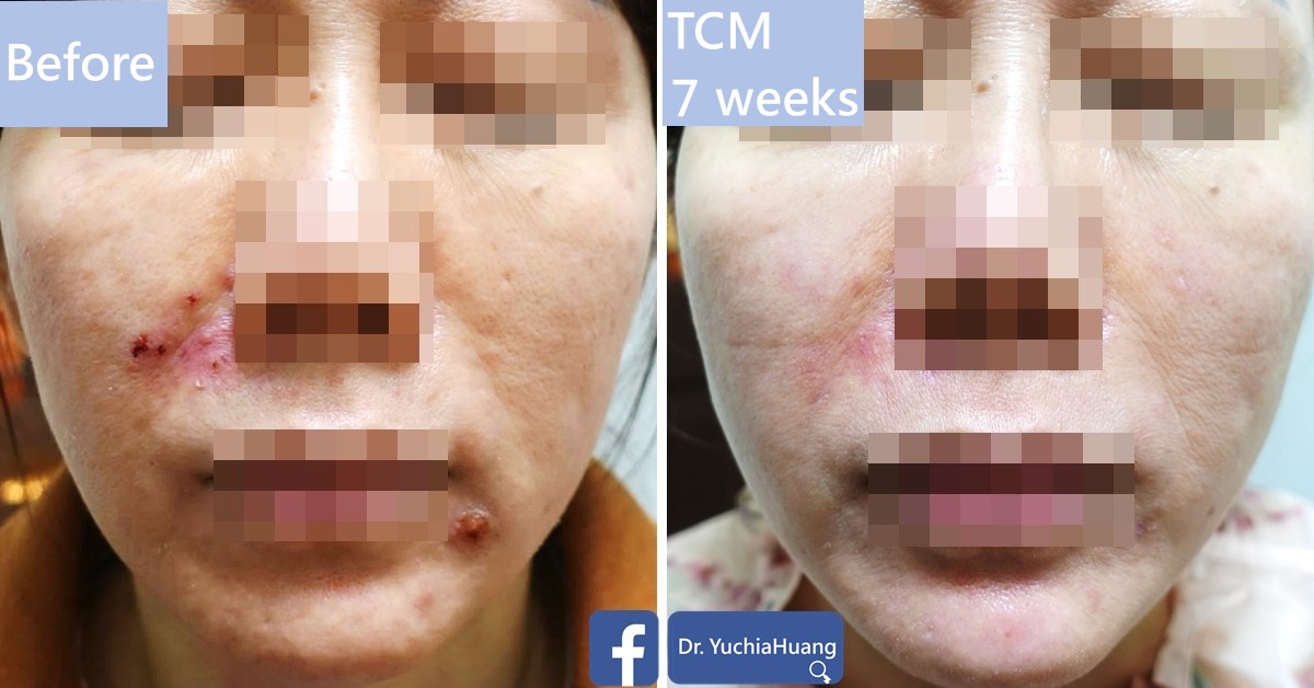 Before-and-after photos of a face with red patches, features obscured, labelled “Before” and “TCM 7 weeks”