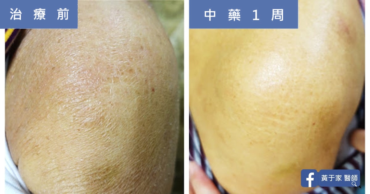 類固醇解決不了的皮膚乾癢（圖 1）