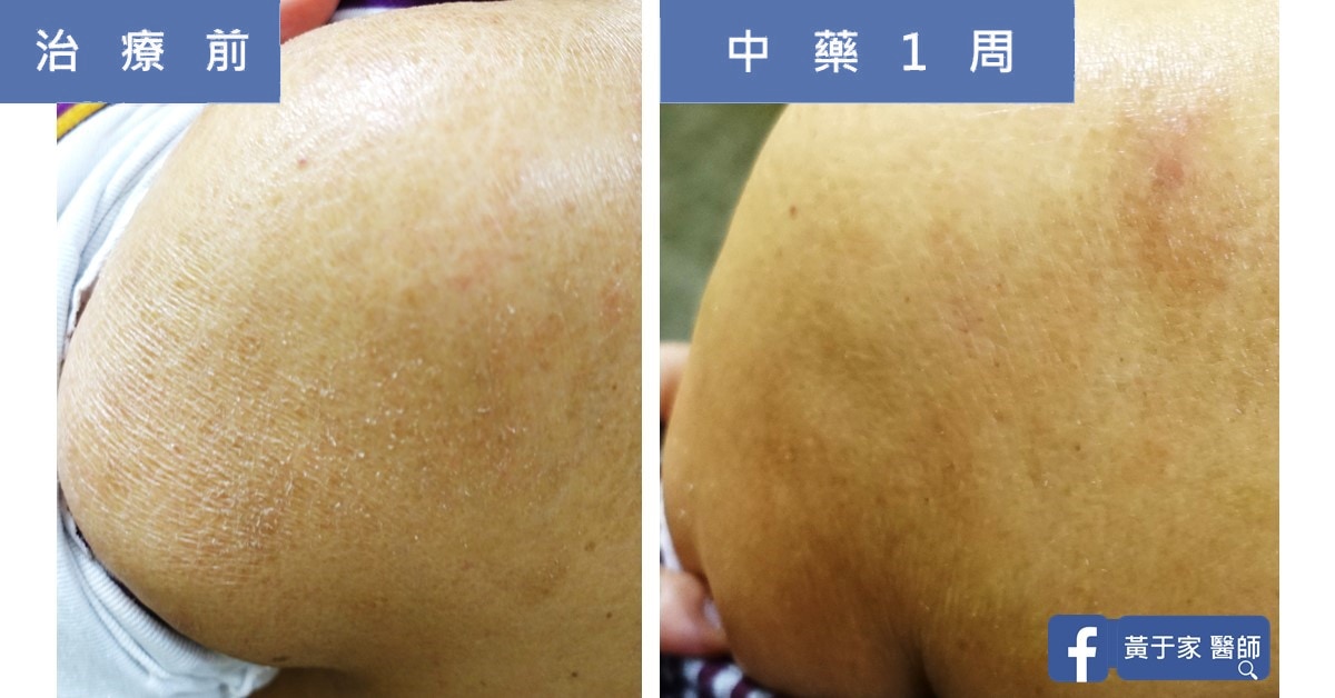 類固醇解決不了的皮膚乾癢（圖 2）