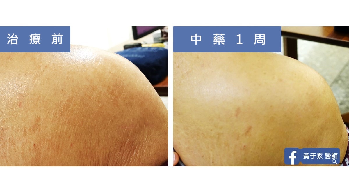類固醇解決不了的皮膚乾癢（圖 3）