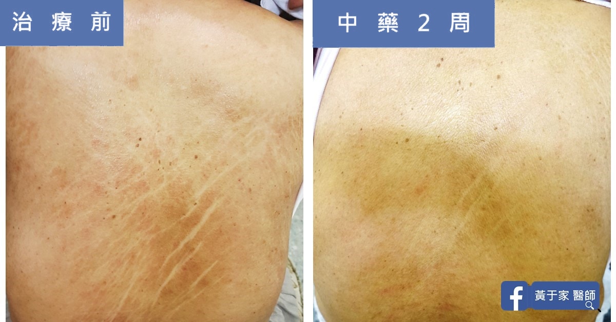類固醇解決不了的皮膚乾癢（圖 4）