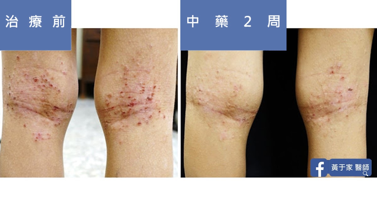 完全沒擦乳液的異位性皮膚炎(圖 1)
