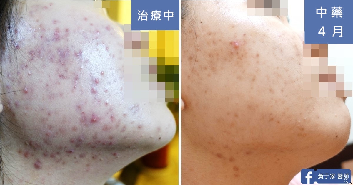 用經方全面引爆深埋藏的卡比獸（圖 4）