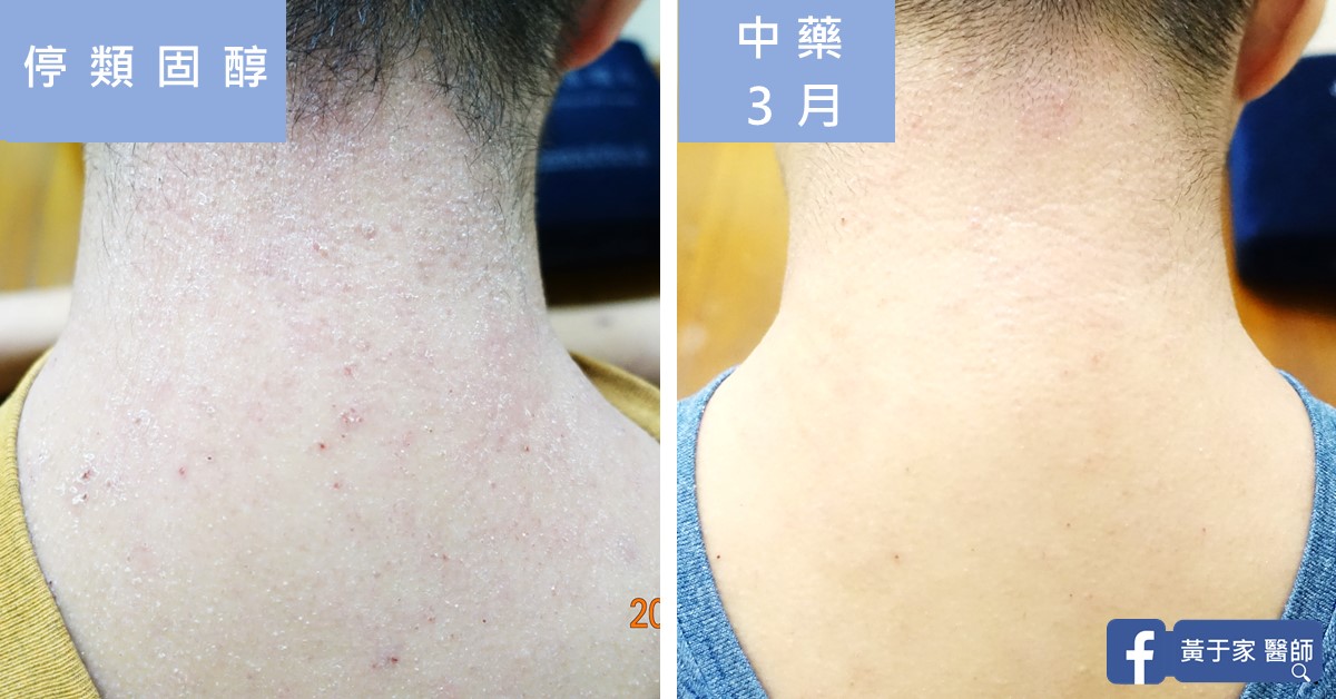 同一位患者頸部的比對,左標示「停類固醇」,右標示「中藥 3 月」
