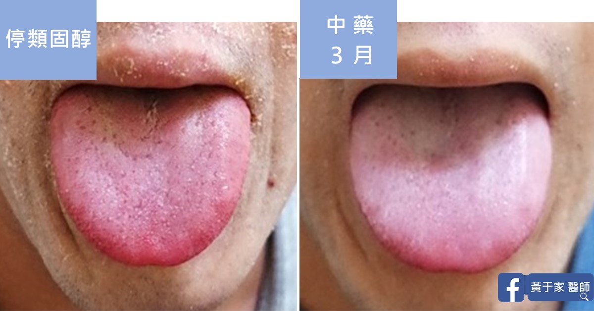 同一位患者舌象的比對,左標示「停類固醇」,右標示「中藥 3 月」