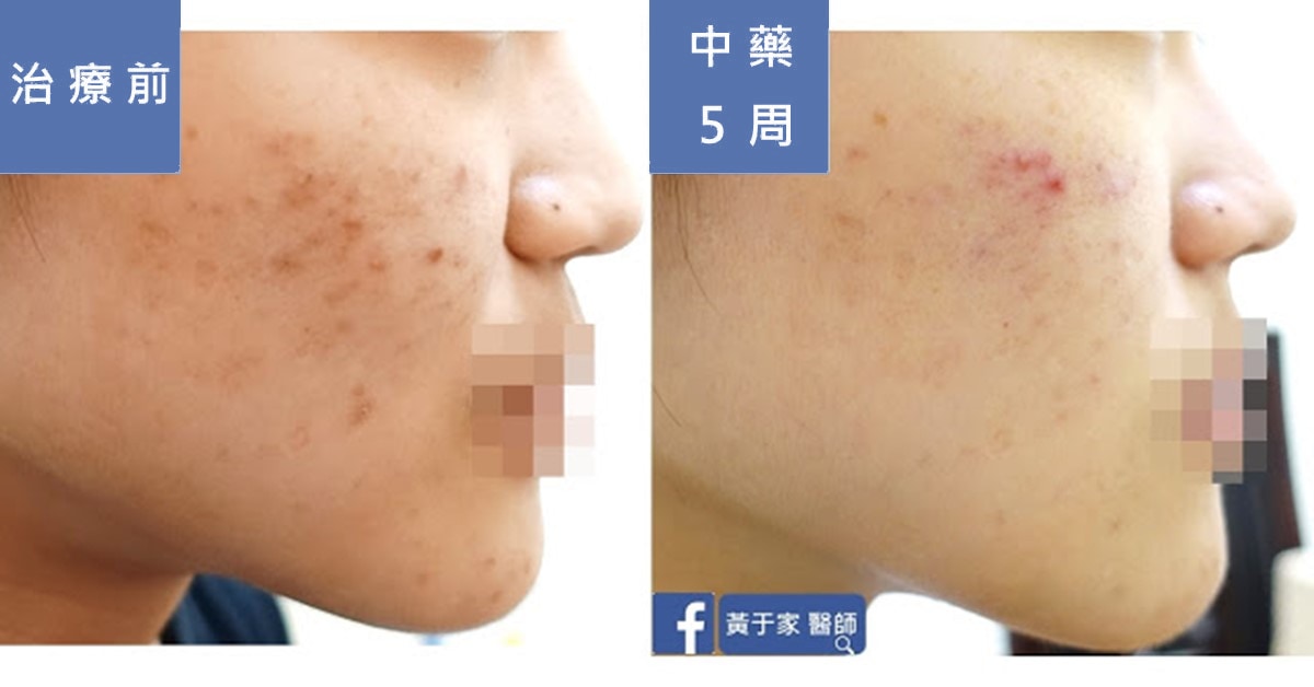 加速擺脫咖啡色痘疤 - 中醫經方 5 周很可以(圖 1)