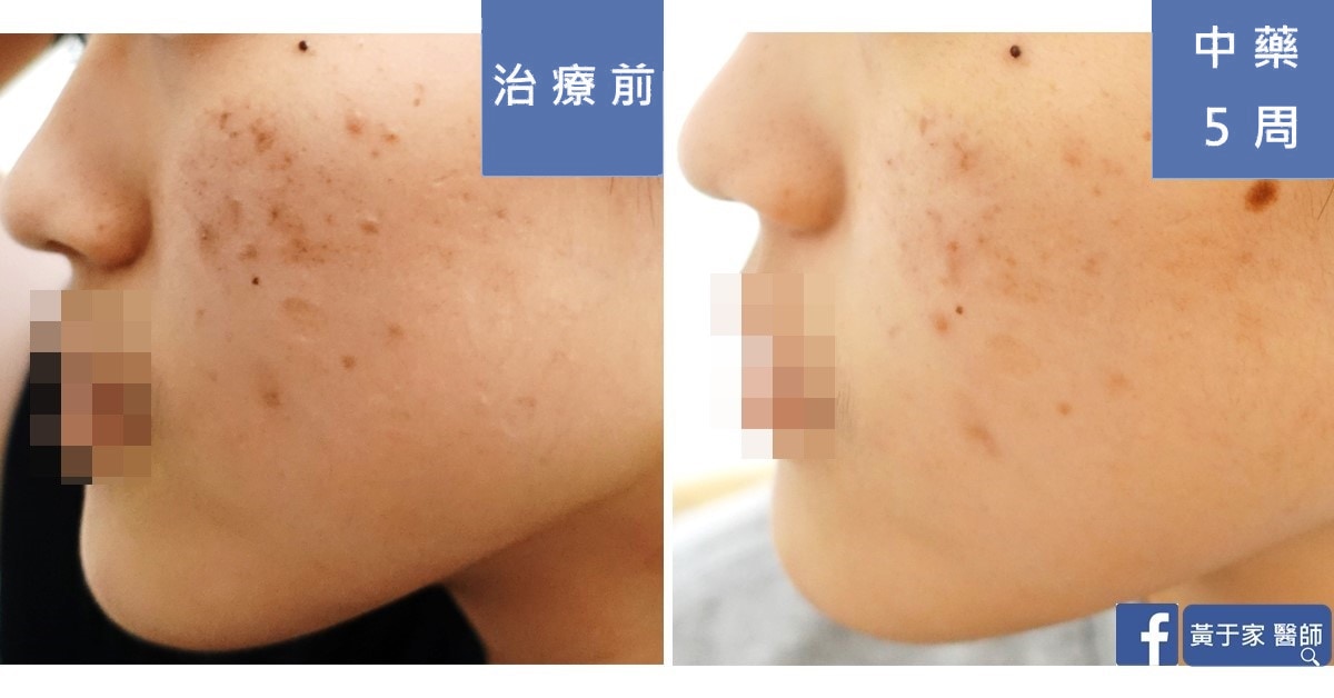 加速擺脫咖啡色痘疤 - 中醫經方 5 周很可以(圖 2)