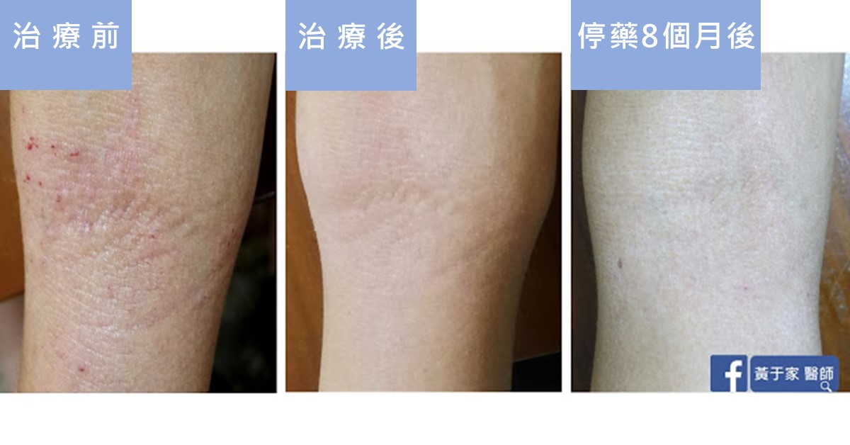 同一位患者關節彎曲處皮膚的三張比對,依序標示「治療前」「治療後」「停藥 8 個月後」,治療前可見紅色抓痕