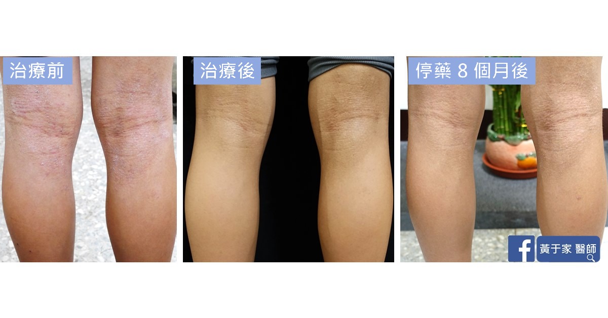 同一位患者雙膝後側膝窩的三張比對,依序標示「治療前」「治療後」「停藥 8 個月後」