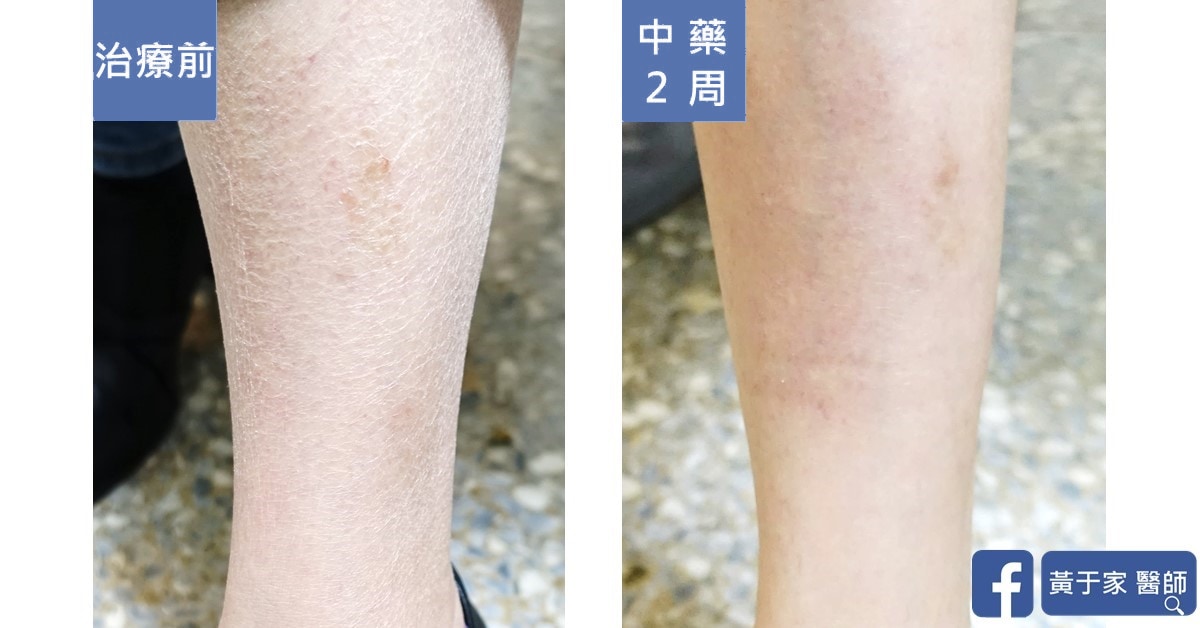 美國藥廠員工小腿皮膚,治療前與中藥 2 週對照