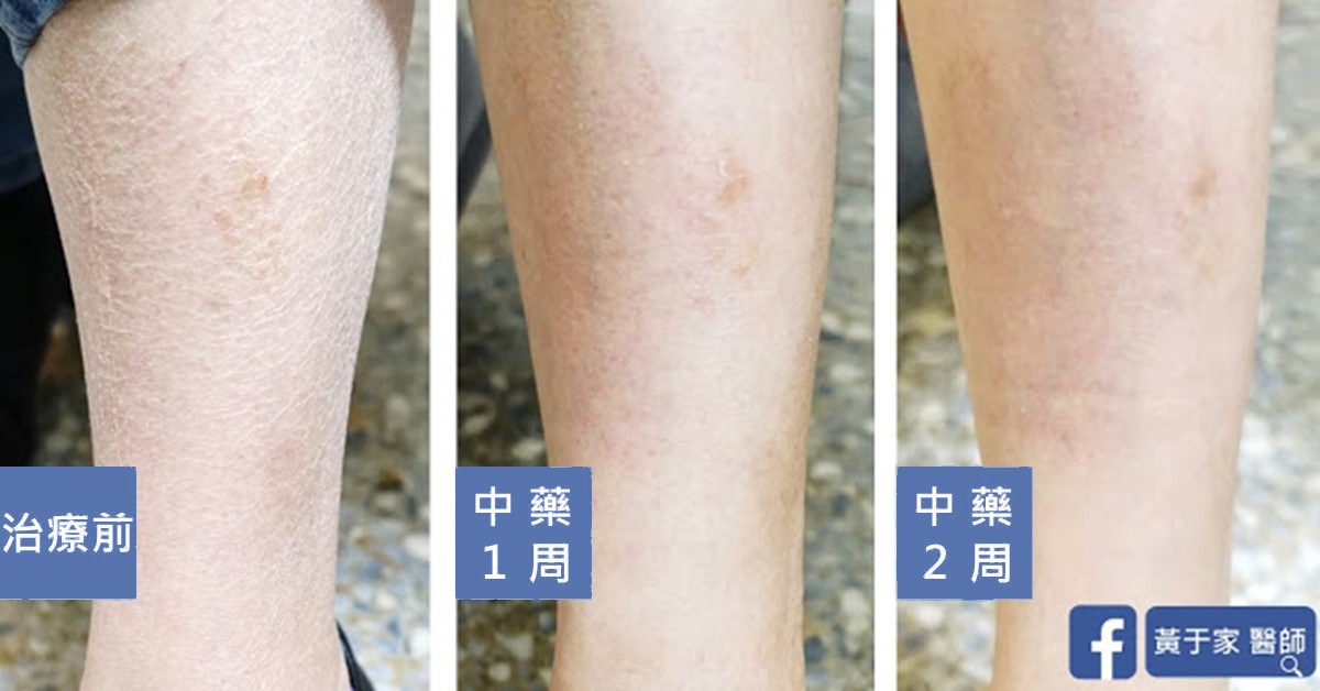 美國藥廠員工小腿皮膚,治療前、中藥 1 週、2 週對照