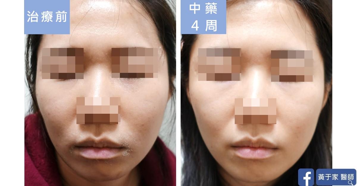 同一位患者正面臉部的比對,左標示「治療前」,嘴角周圍脫屑;右標示「中藥 4 周」