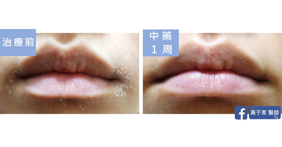 同一位患者嘴唇的比對,左標示「治療前」,唇周白色脫屑;右標示「中藥 1 周」