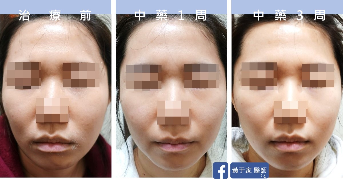 同一位患者正面臉部的三張並排照片,依序標示「治療前」「中藥 1 周」「中藥 3 周」