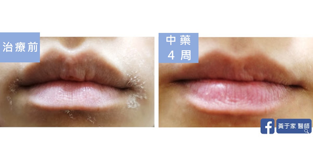 同一位患者嘴唇的比對,左標示「治療前」,右標示「中藥 4 周」,唇色較紅潤