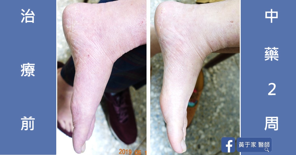 誰說中醫就只能是慢慢吃、慢慢調?手、腳、臉、以及身體不適(圖 3)
