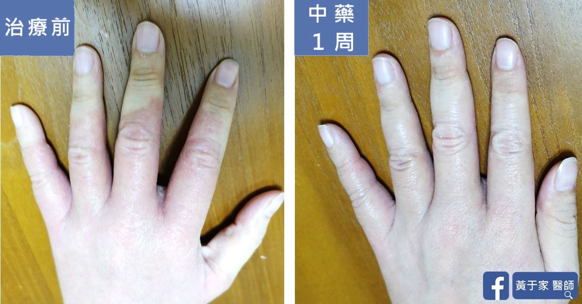 誰說中醫就只能是慢慢吃、慢慢調?手、腳、臉、以及身體不適(圖 4)