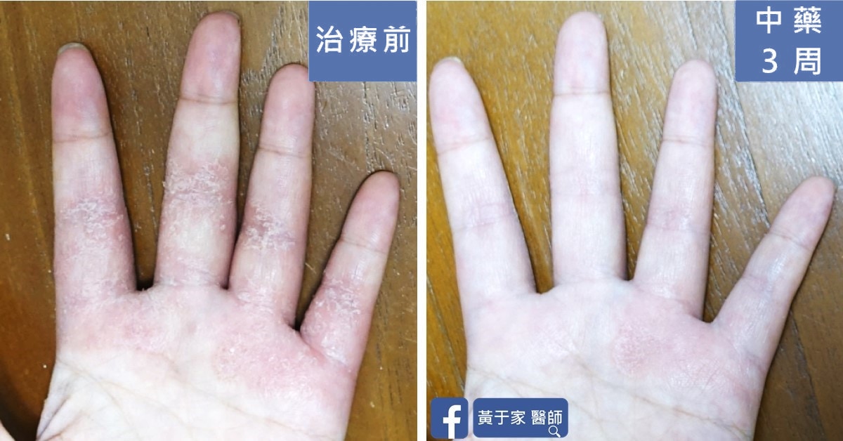 誰說中醫就只能是慢慢吃、慢慢調?手、腳、臉、以及身體不適(圖 5)