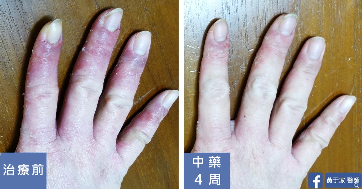 半年的手部濕疹(圖 1)