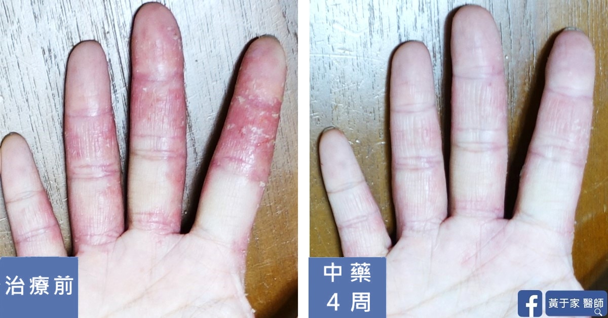 半年的手部濕疹(圖 2)