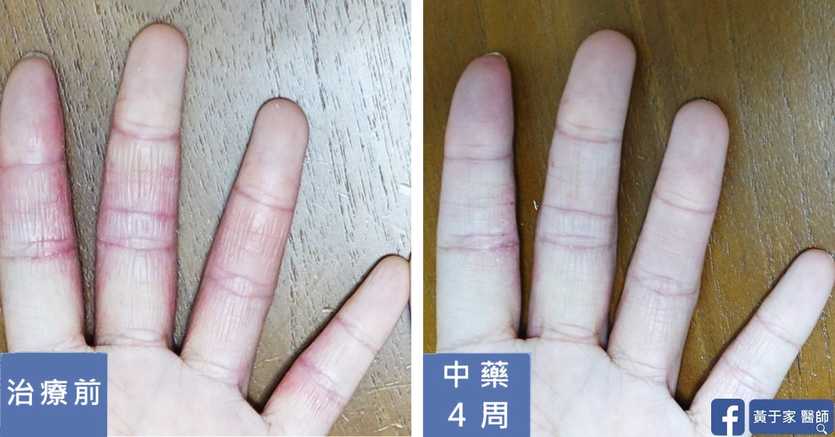 半年的手部濕疹(圖 3)