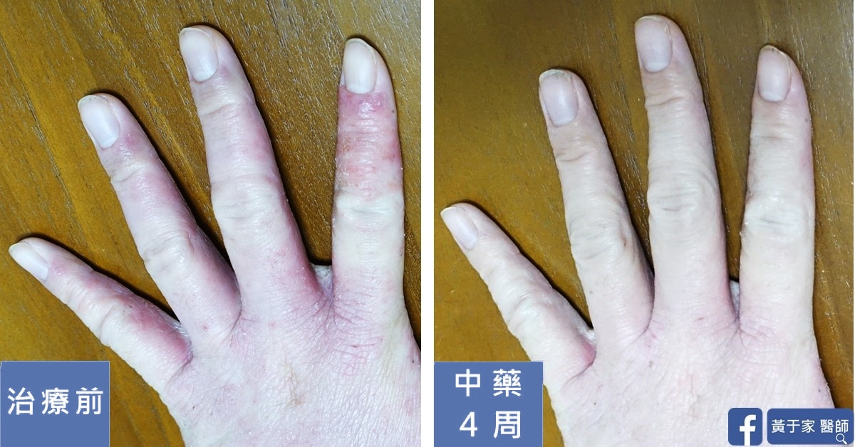 半年的手部濕疹(圖 4)