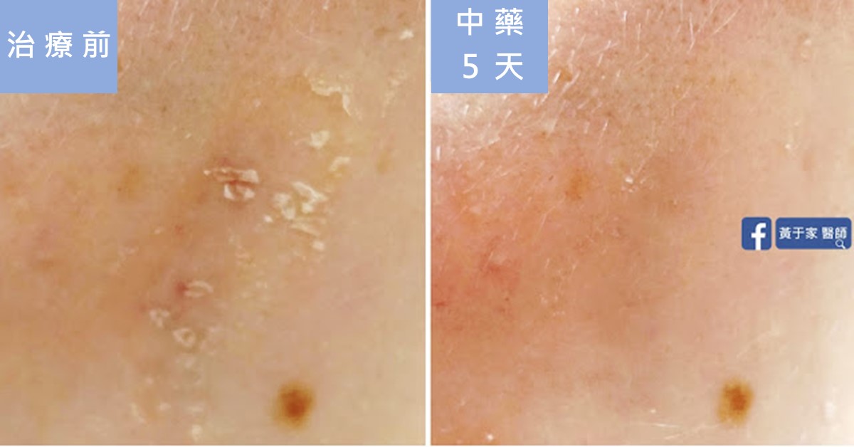 臉部皮膚特寫比對,左標示「治療前」有脫屑,右標示「中藥 5 天」