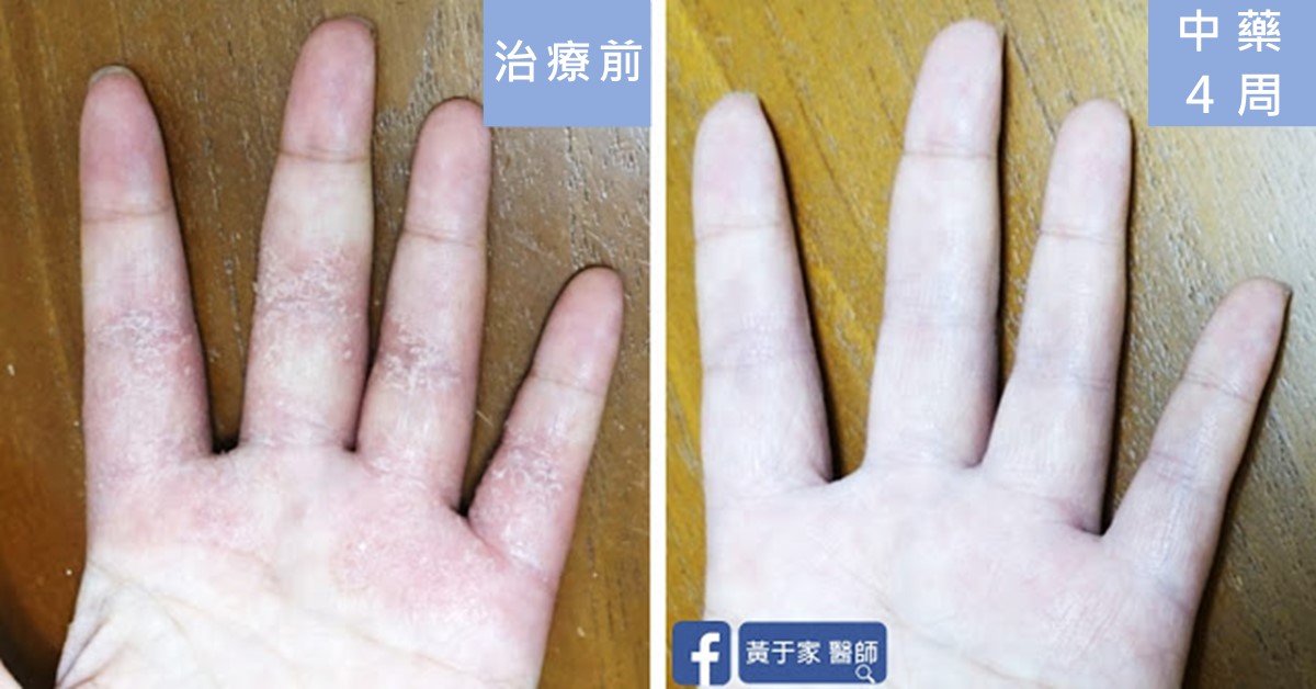 手部濕疹患者治療前後皮膚外觀比對