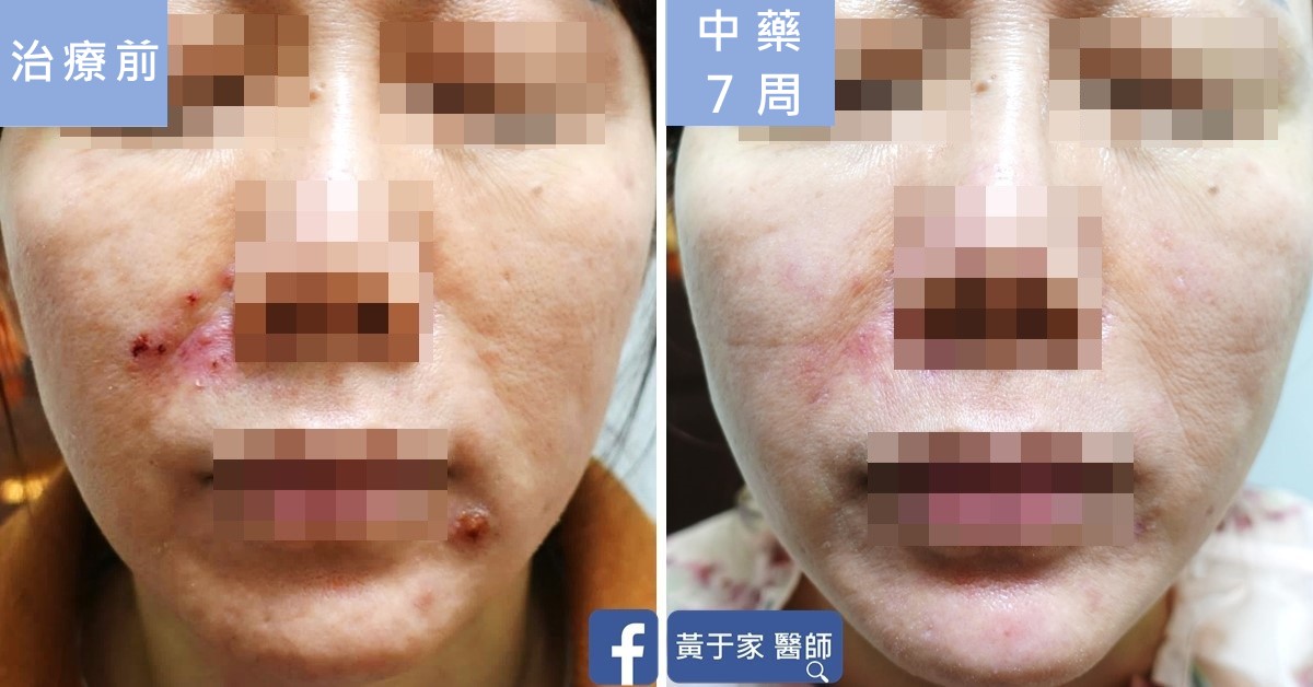 同一位患者正面臉部的比對,左標示「治療前」,可見鼻翼旁與嘴角破損;右標示「中藥 7 周」