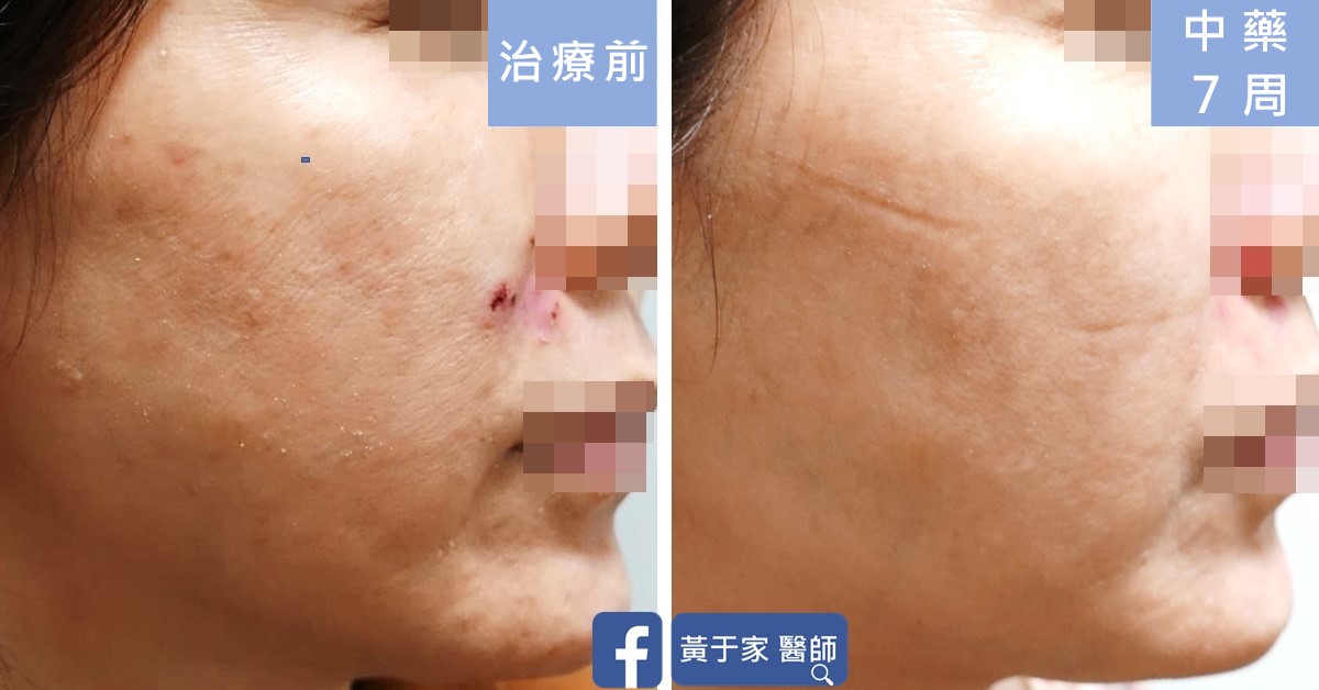 同一位患者右側臉的比對,左標示「治療前」,可見脫屑與鼻翼旁破損;右標示「中藥 7 周」