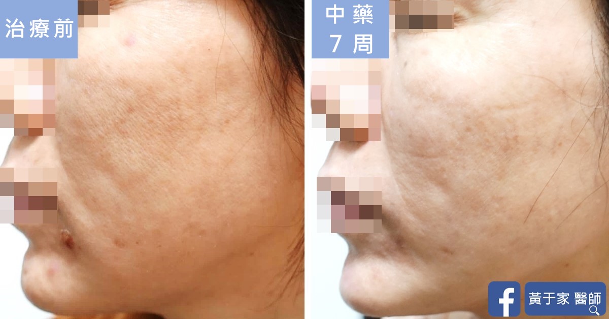 同一位患者左側臉的比對,左標示「治療前」,右標示「中藥 7 周」