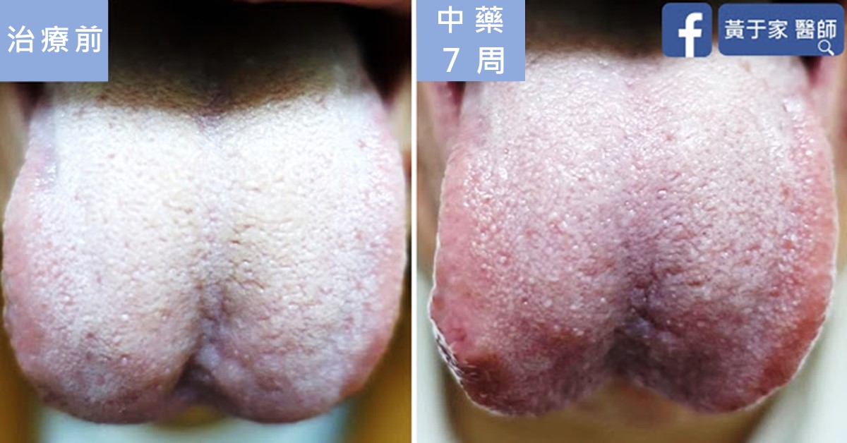 同一位患者舌象的比對,左標示「治療前」,舌苔厚膩、舌色偏淡;右標示「中藥 7 周」,舌色較紅潤