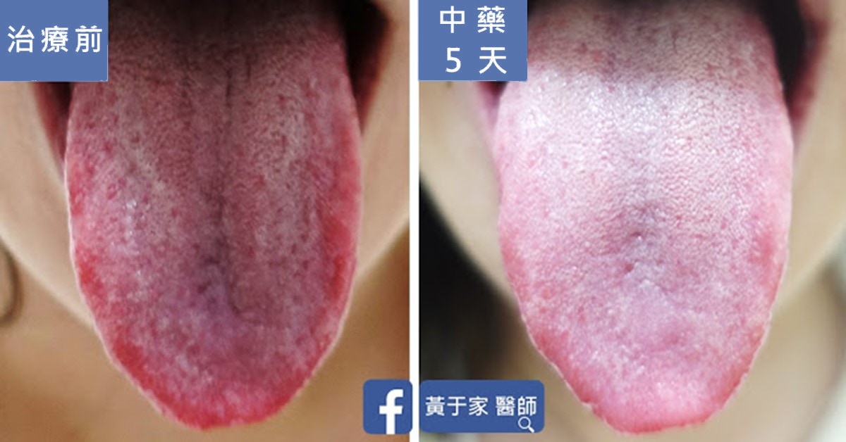 脫下患者的紅舞鞋！- 中醫的治療是否能改變情緒狀態？