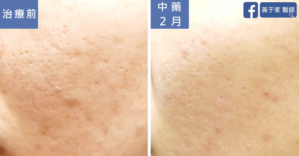 睪固酮超標四倍的多囊性卵巢患者(圖 2)