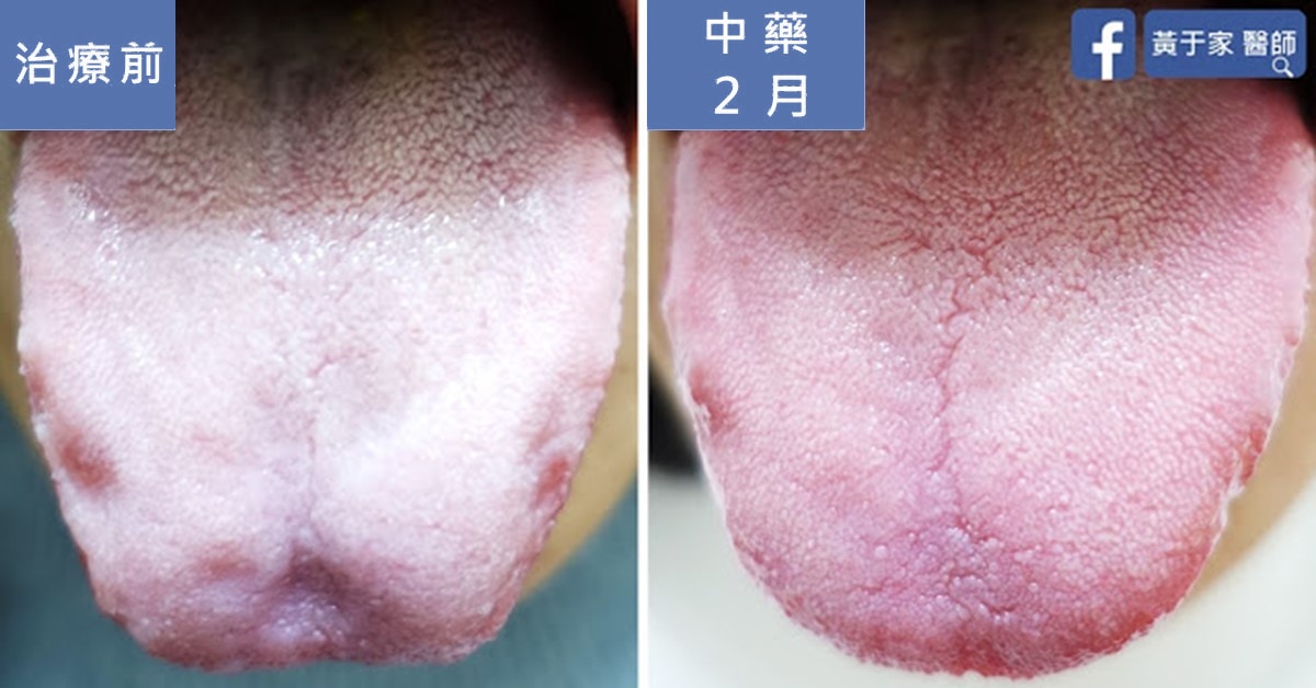 睪固酮超標四倍的多囊性卵巢患者(圖 3)
