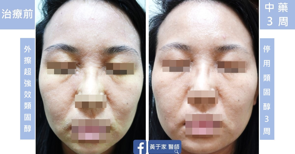 同一位患者正面臉部的比對,左標示「治療前」與「外擦超強效類固醇」,右標示「中藥 3 周」與「停用類固醇 3 周」